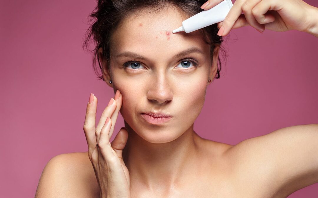 How Can CBD Help with Acne?